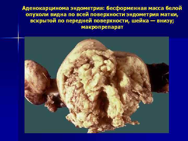 Аденокарцинома эндометрия: бесформенная масса белой опухоли видна по всей поверхности эндометрия матки, вскрытой по