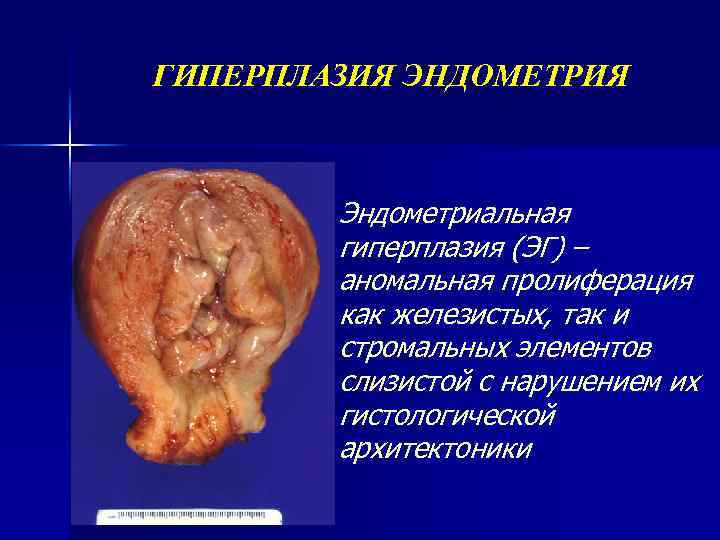 ГИПЕРПЛАЗИЯ ЭНДОМЕТРИЯ Эндометриальная гиперплазия (ЭГ) – аномальная пролиферация как железистых, так и стромальных элементов