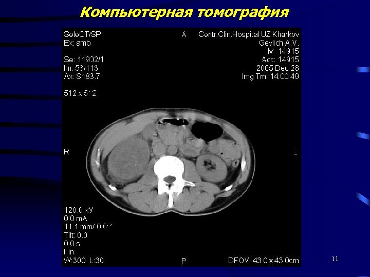 Компьютерная томография 11 