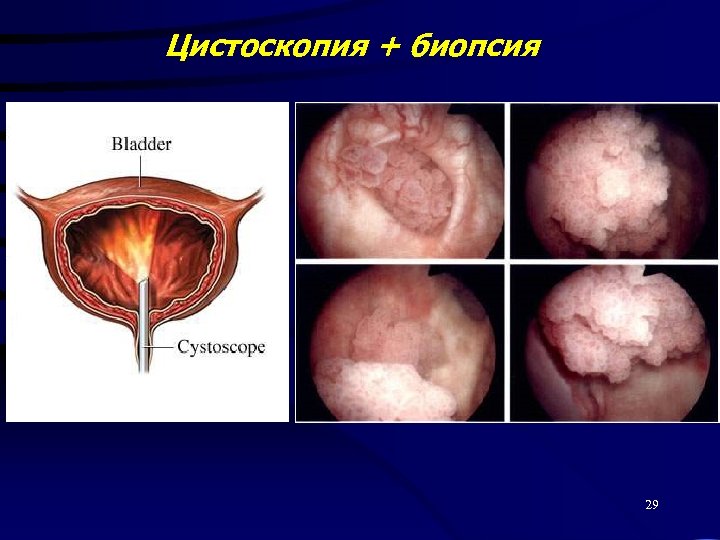 Цистоскопия + биопсия 29 