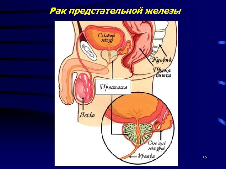 Рак предстательной железы 32 