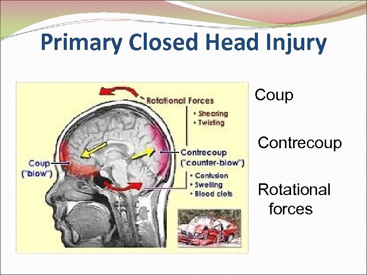 Primary Closed Head Injury Coup Contrecoup Rotational forces 