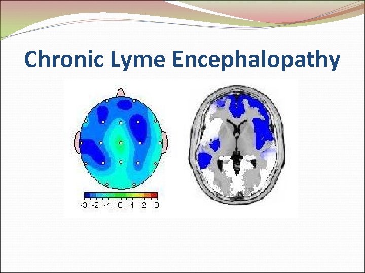 Chronic Lyme Encephalopathy 