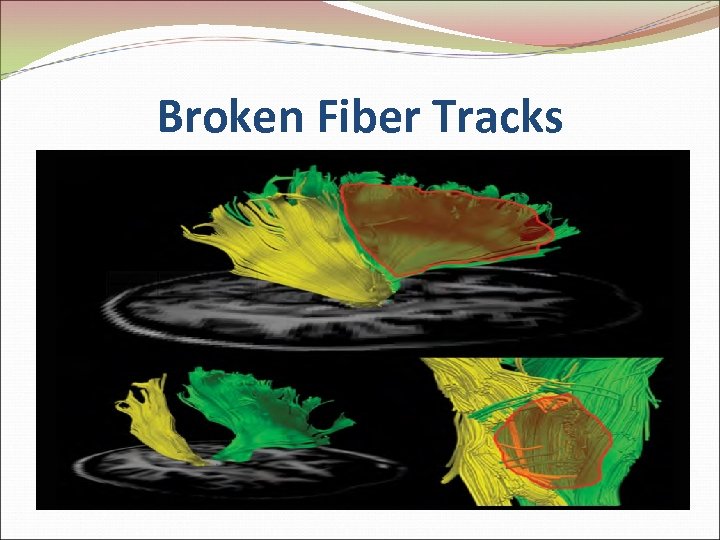 Broken Fiber Tracks 