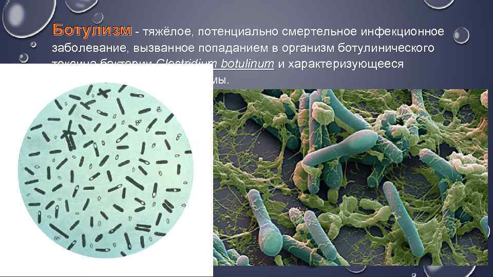 Ботулизм - тяжёлое, потенциально смертельное инфекционное заболевание, вызванное попаданием в организм ботулинического токсина бактерии