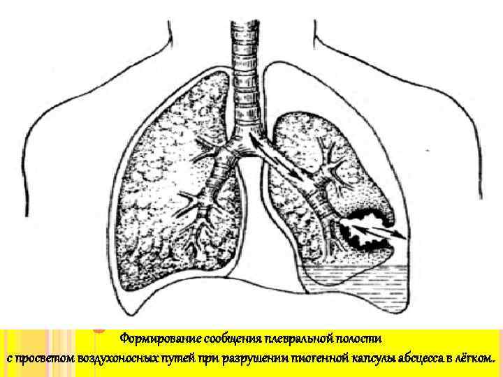 Абсцесс легкого рисунок