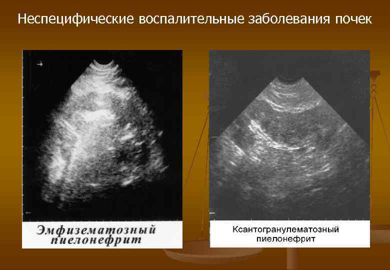 Неспецифические воспалительные заболевания почек 