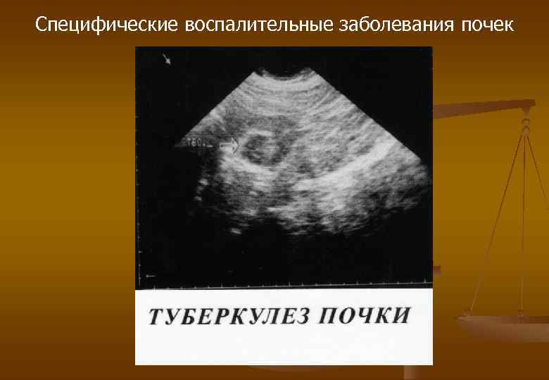 Специфические воспалительные заболевания почек 
