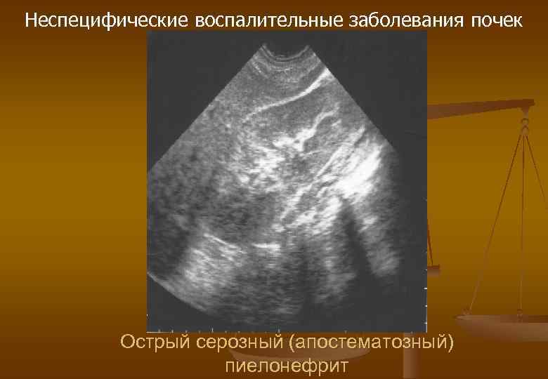 Неспецифические воспалительные заболевания почек Острый серозный (апостематозный) пиелонефрит 