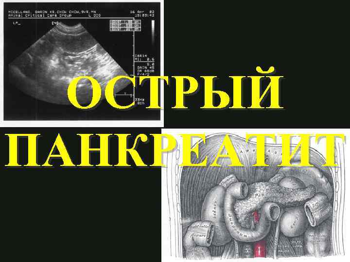 ОСТРЫЙ ПАНКРЕАТИТ 