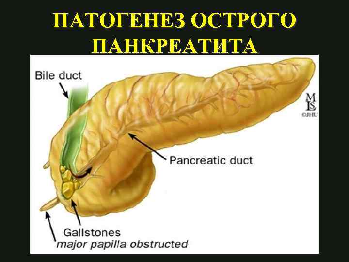 Патогенез острого панкреатита схема