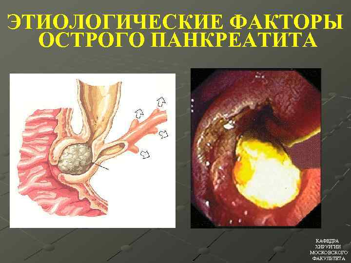 ЭТИОЛОГИЧЕСКИЕ ФАКТОРЫ ОСТРОГО ПАНКРЕАТИТА КАФЕДРА ХИРУРГИИ МОСКОВСКОГО ФАКУЛЬТЕТА 