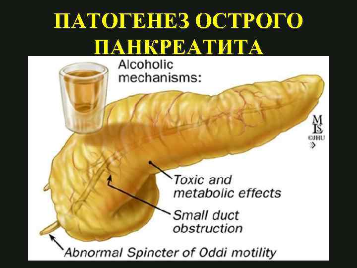 ПАТОГЕНЕЗ ОСТРОГО ПАНКРЕАТИТА 