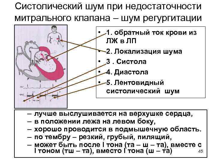 Шум на митральном клапане