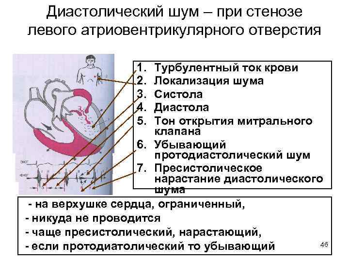 Диастолический шум – при стенозе левого атриовентрикулярного отверстия 1. 2. 3. 4. 5. Турбулентный