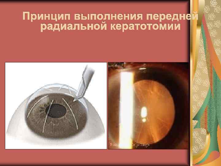 Принцип выполнения передней радиальной кератотомии 