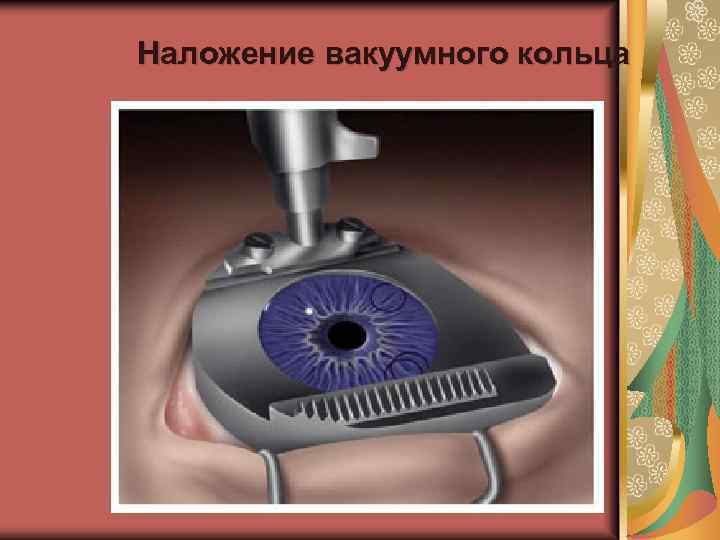 Наложение вакуумного кольца 