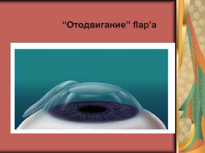 “Отодвигание” flap’a 