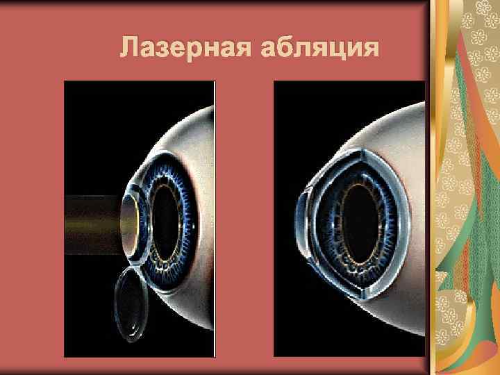 Лазерная абляция 