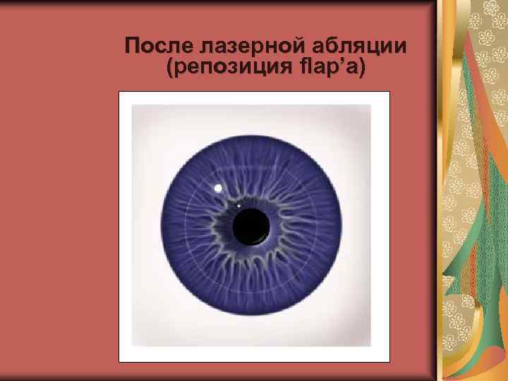 После лазерной абляции (репозиция flap’a) 