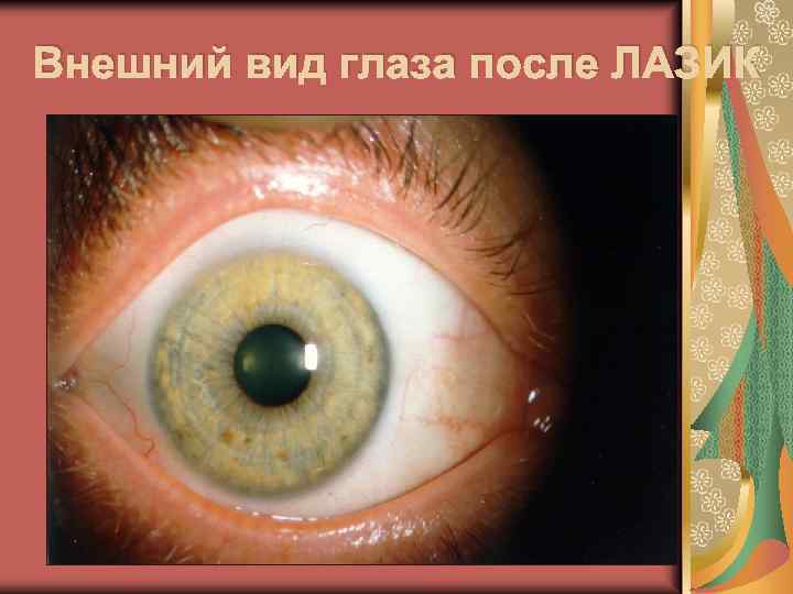 Внешний вид глаза после ЛАЗИК 