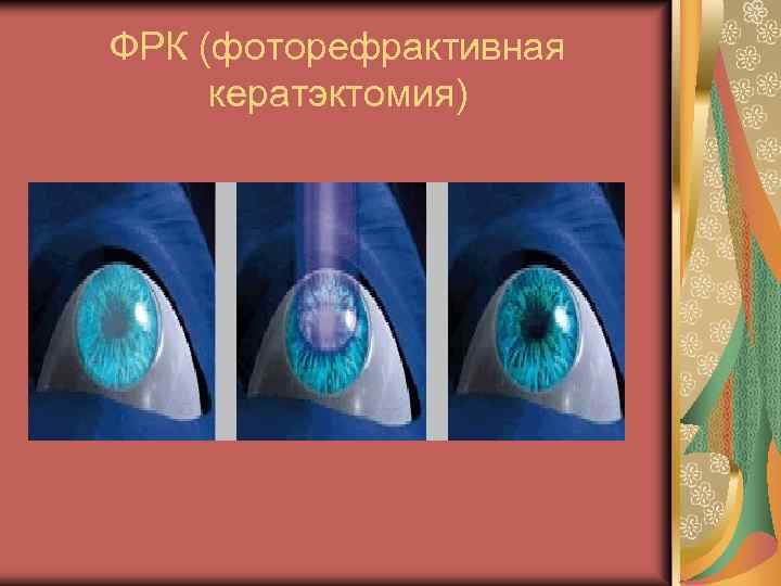 Фрк коррекция зрения. Фоторефрактивная кератэктомия ФРК. Коррекция зрения по технологии ФРК (фоторефракционная кератэктомия). Трансэпителиальная фоторефракционная кератэктомия. Фоторефракционная операция что это.