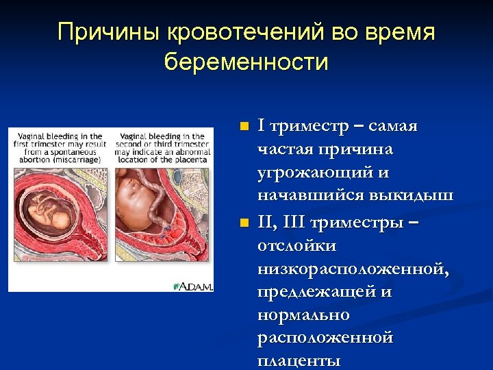 Причины кровотечений во время беременности n n I триместр – самая частая причина угрожающий
