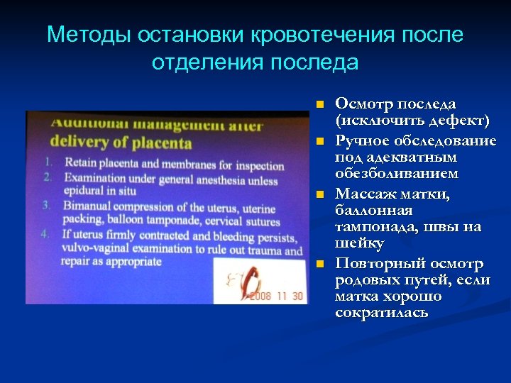 Методы остановки кровотечения после отделения последа n n Осмотр последа (исключить дефект) Ручное обследование