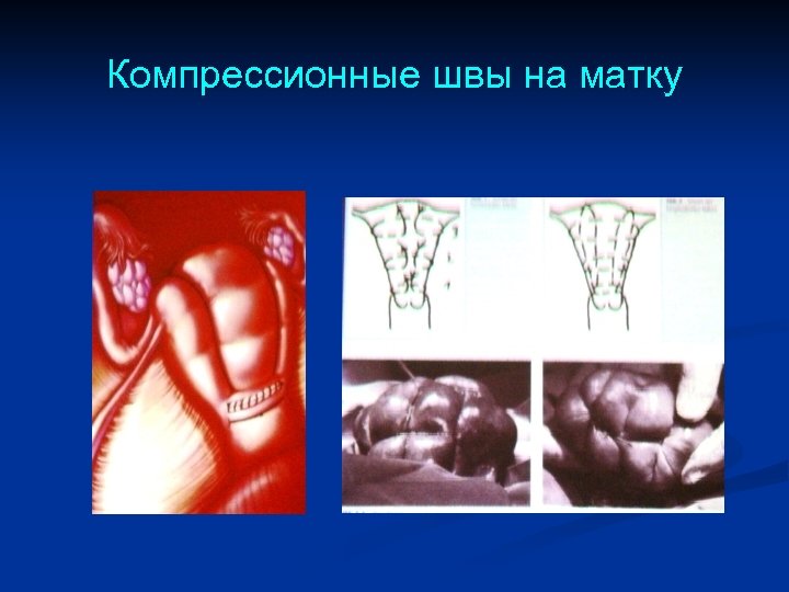 Компрессионные швы на матку 