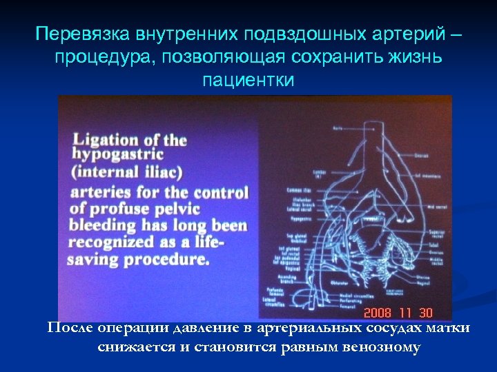 Перевязка внутренних подвздошных артерий – процедура, позволяющая сохранить жизнь пациентки После операции давление в