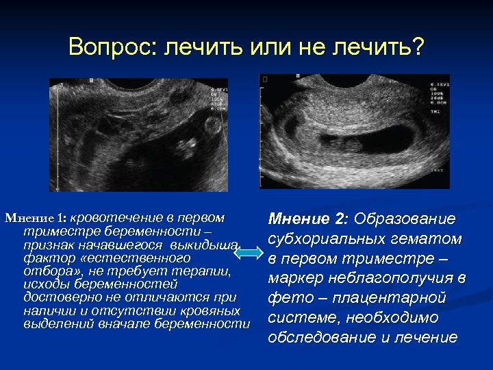 Вопрос: лечить или не лечить? Мнение 1: кровотечение в первом триместре беременности – признак
