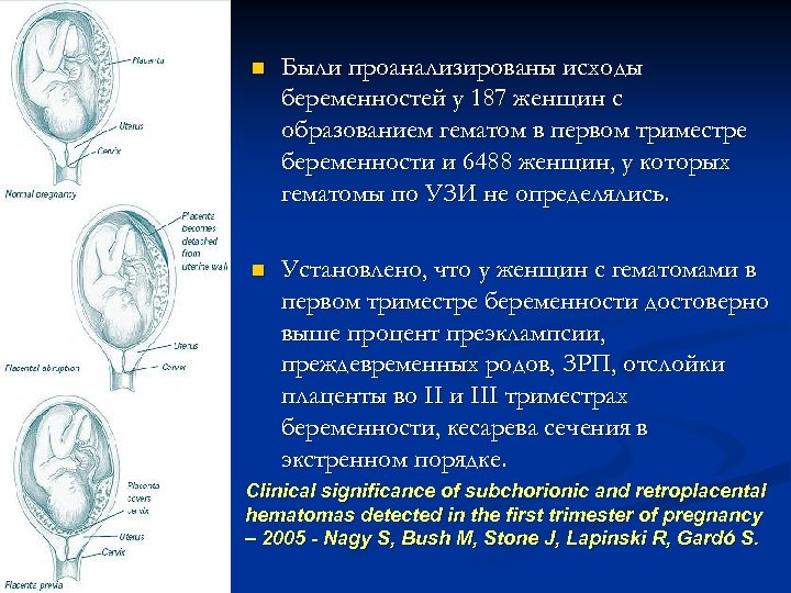n Были проанализированы исходы беременностей у 187 женщин с образованием гематом в первом триместре