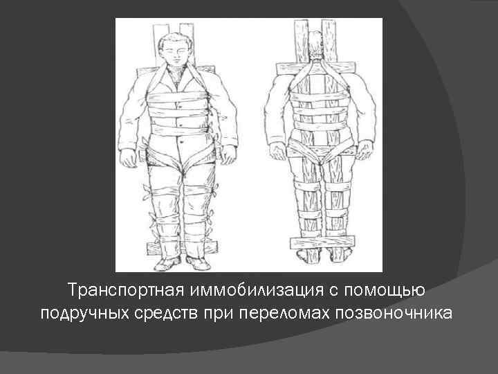 Транспортная иммобилизация с помощью подручных средств при переломах позвоночника 