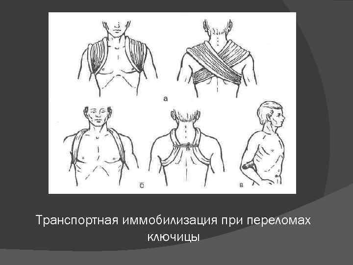 Транспортная иммобилизация при переломах ключицы 