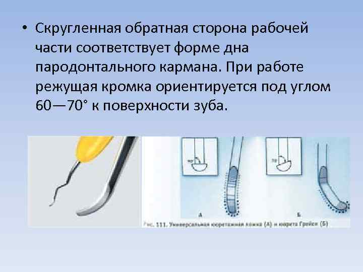  • Скругленная обратная сторона рабочей части соответствует форме дна пародонтального кармана. При работе