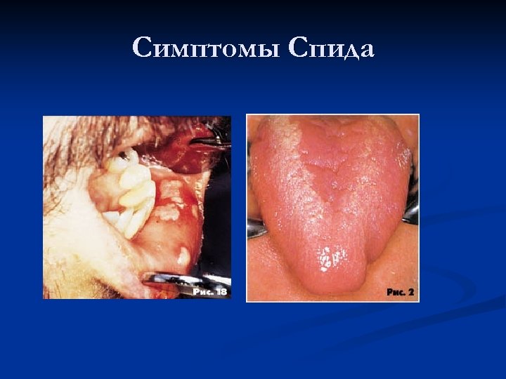 Симптомы Спида 