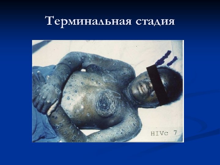 Терминальная стадия 