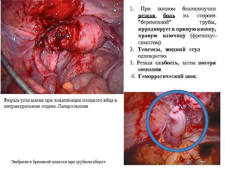 1. При полном благополучии резкая боль на стороне 