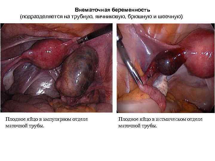Внематочная беременность (подразделяется на трубную, яичниковую, брюшную и шеечную) Плодное яйцо в ампулярном отделе