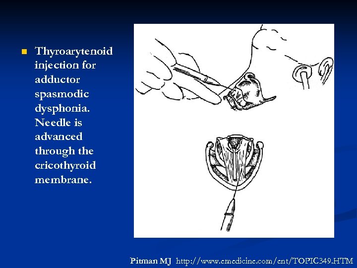n Thyroarytenoid injection for adductor spasmodic dysphonia. Needle is advanced through the cricothyroid membrane.