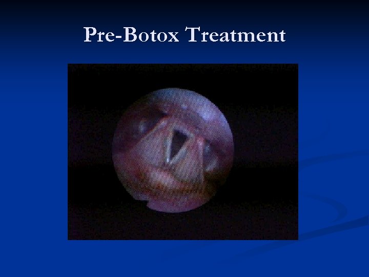Pre-Botox Treatment 