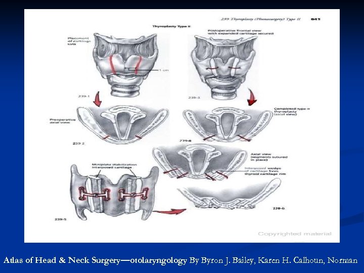 Atlas of Head & Neck Surgery—otolaryngology By Byron J. Bailey, Karen H. Calhoun, Norman