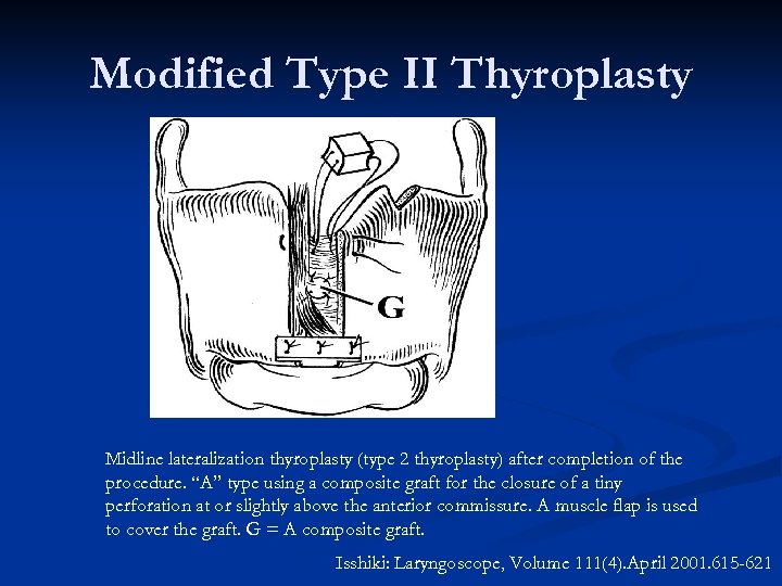 Modified Type II Thyroplasty Midline lateralization thyroplasty (type 2 thyroplasty) after completion of the