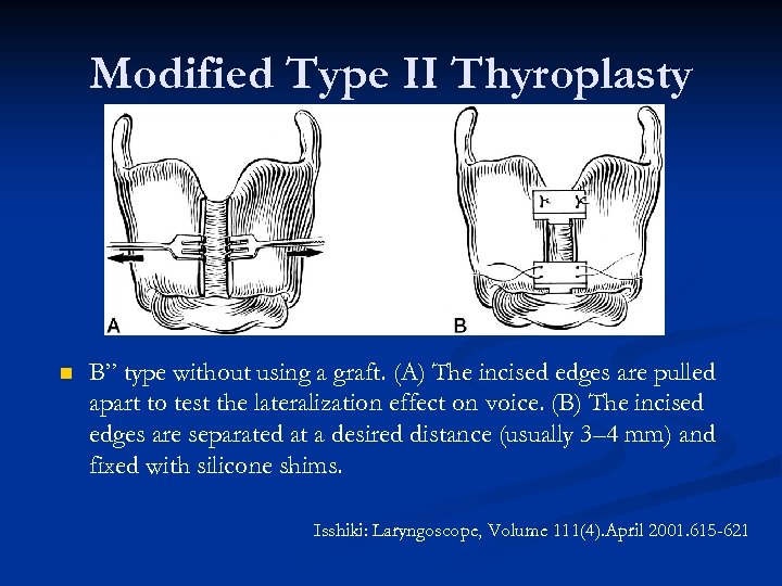 Modified Type II Thyroplasty n B” type without using a graft. (A) The incised