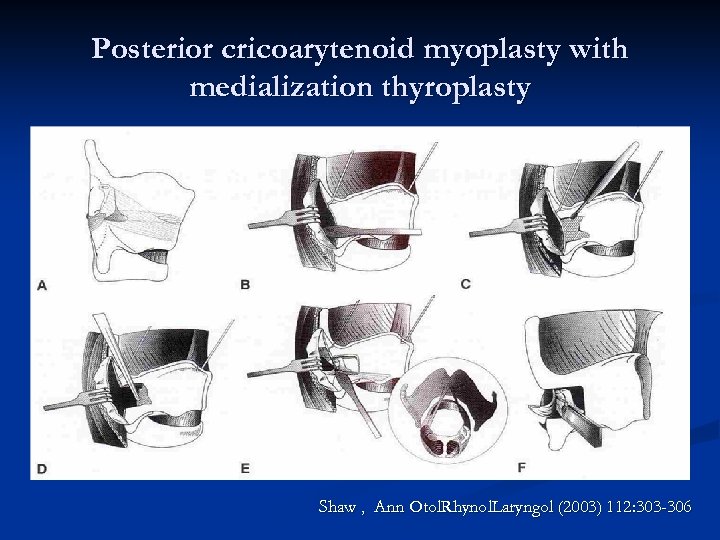 Posterior cricoarytenoid myoplasty with medialization thyroplasty Shaw , Ann Otol. Rhynol. Laryngol (2003) 112: