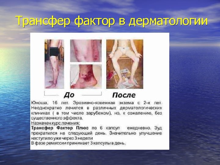 Трансфер фактор в дерматологии 