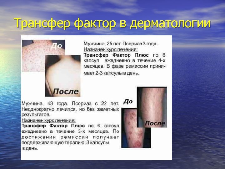 Трансфер фактор в дерматологии 