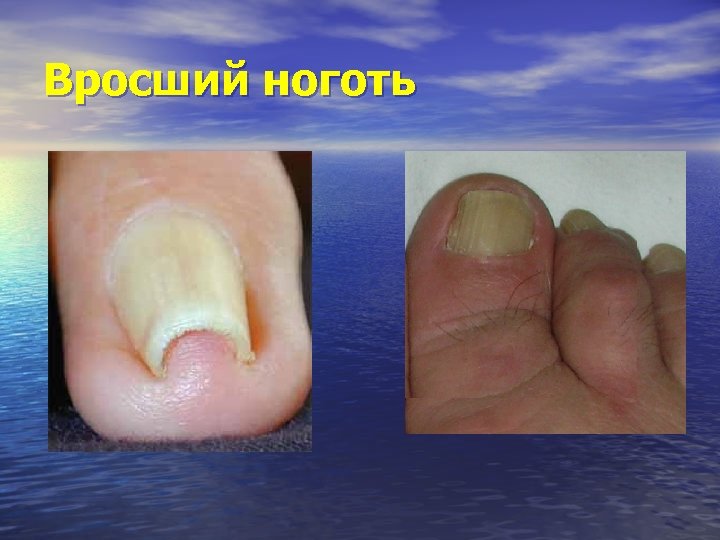 Вросший ноготь 