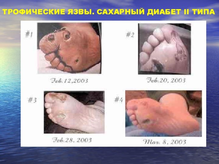 ТРОФИЧЕСКИЕ ЯЗВЫ. САХАРНЫЙ ДИАБЕТ II ТИПА 