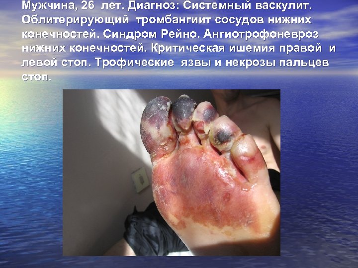 Мужчина, 26 лет. Диагноз: Системный васкулит. Облитерирующий тромбангиит сосудов нижних конечностей. Синдром Рейно. Ангиотрофоневроз